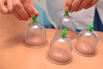 Cupping therapy